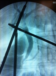 Gallbladder and Bile Duct Surgery